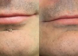 🔥Muwix®2-in-1 Microneedle & Hydrocolloid Patch🍀| Removes Raised Moles, Acne, Flat Warts & Skin Tags | Helps Improve Wrinkles, Scars & Blemishes | Invisible Patches for Face & Body