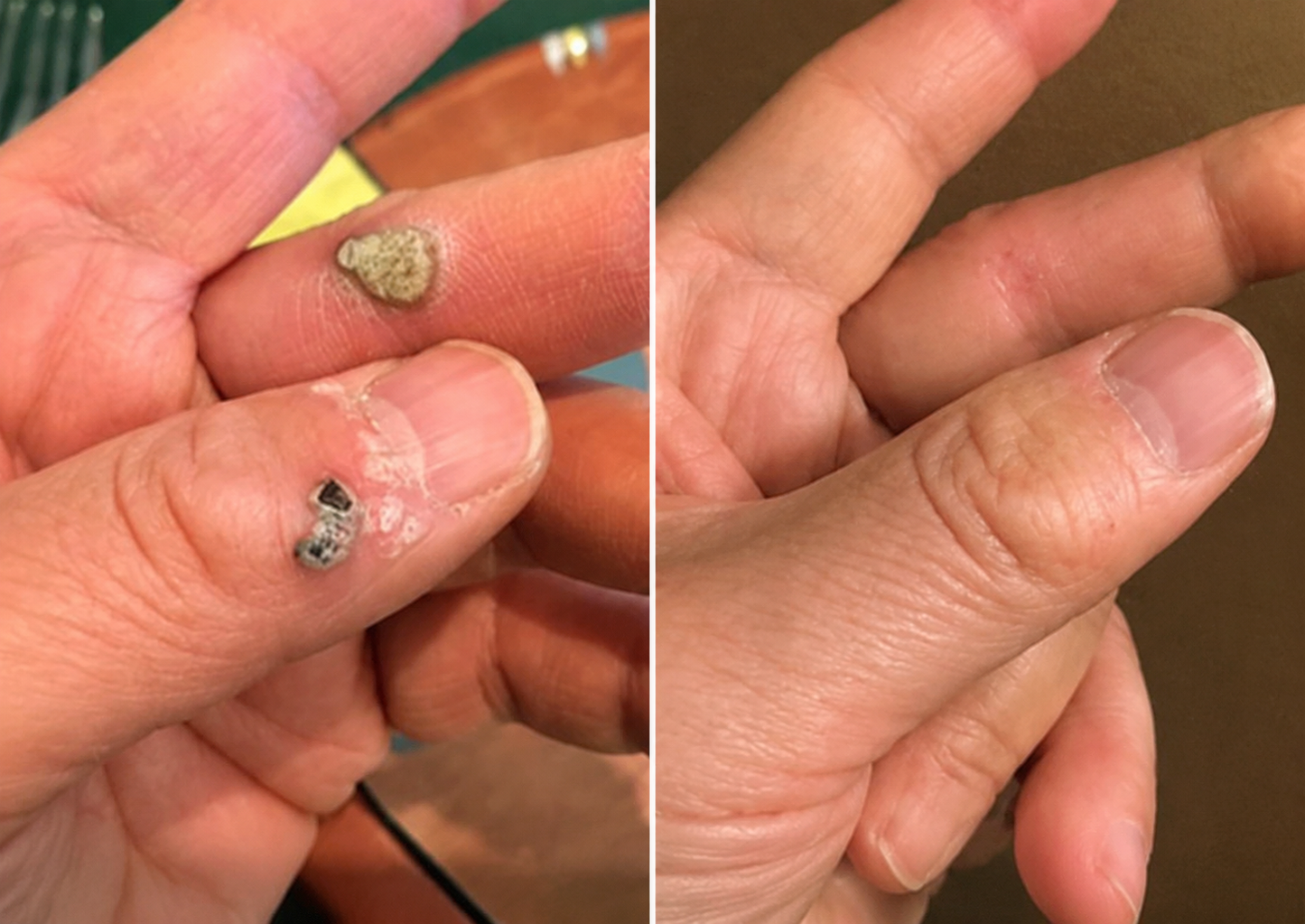🔥Muwix®2-in-1 Microneedle & Hydrocolloid Patch🍀| Removes Raised Moles, Acne, Flat Warts & Skin Tags | Helps Improve Wrinkles, Scars & Blemishes | Invisible Patches for Face & Body
